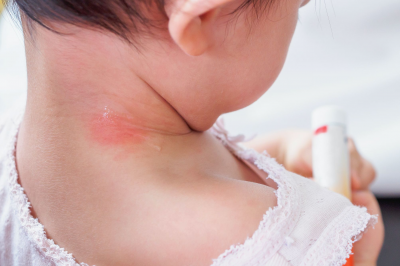 Kenali Jenis Ruam Kulit Pada Bayi